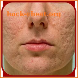 Acne Scar Removal icon