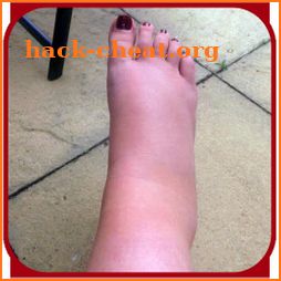 SWOLLEN FEET HOME REMEDIES icon