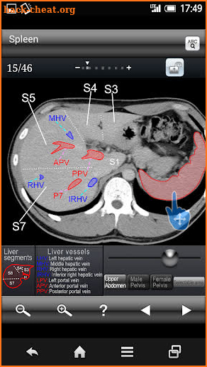 Abdominal CT Sectional Walker screenshot