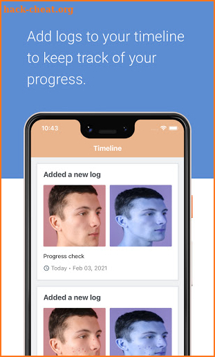 AcneLog: Track your Acne Healing Progress screenshot