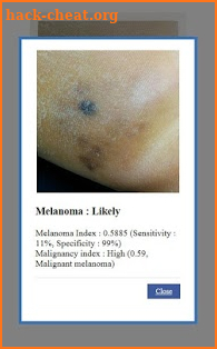 AI Melanoma (Skin Cancer) Detection screenshot