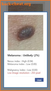 AI Melanoma (Skin Cancer) Detection screenshot