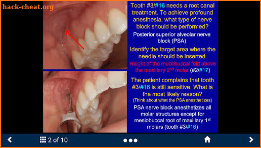 Dental Anesthesia - SecondLook screenshot