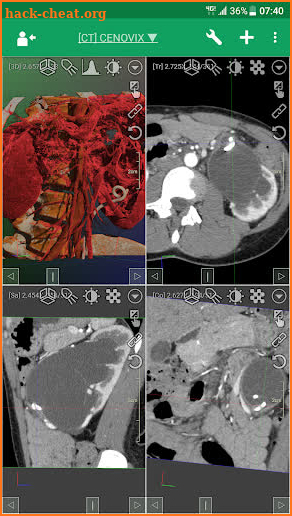 DroidRender - 3D DICOM viewer screenshot