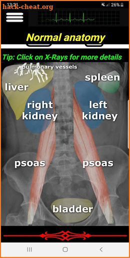 Easy Abdominal X-Ray screenshot