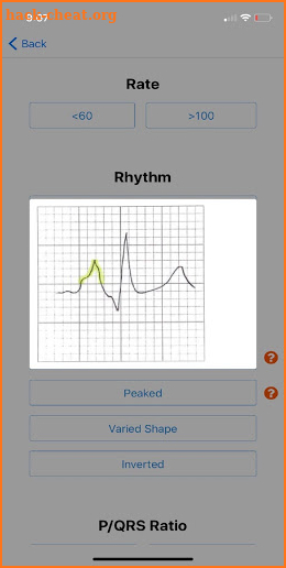 EKG DDX screenshot