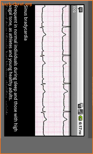 Electrocardiogram ECG Types screenshot