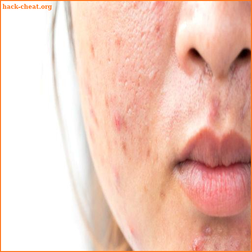 Get Rid of Acne (Guide) screenshot