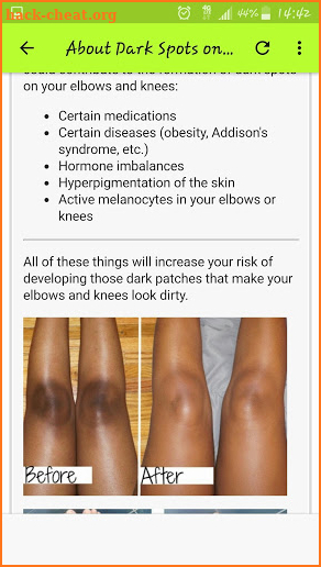 Get Rid Of Dark Knees And Elbows Fast & Naturally screenshot