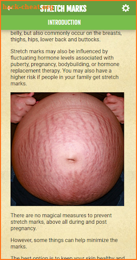 Get rid of STRETCH MARKS - Home Remedies screenshot