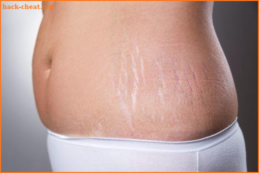 Get Rid Of Stretch Marks Naturally screenshot