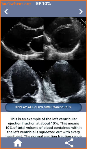 HEART EJECTION FRACTION: HOW TO EYEBALL THE EF screenshot