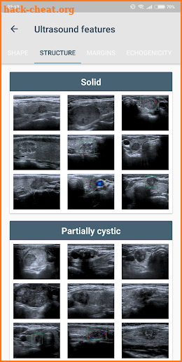 Thyroid Nodules screenshot