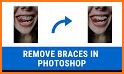 Braces Photo Editor related image