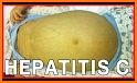 Hepatitis C: Causes, Diagnosis, and Treatment related image