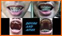 Braces Photo Editor 2020 related image