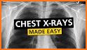 Chest X-Ray Interpretation related image