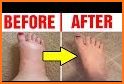 SWOLLEN FEET HOME REMEDIES related image