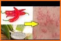 Scabies Natural & Home Remedies related image