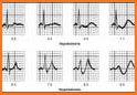 ECG Clinical Interpretation related image