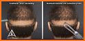 Hair Transplant Simulation related image