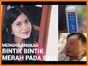 tips simpel cara menghilangkan bentol pada bayi related image