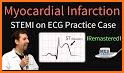 ECG Interpretation MIE related image