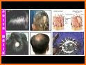 Natural Baldness Treatments related image