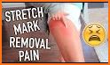 STRETCH MARK REMOVAL related image