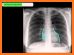 Interpretation Chest X Ray related image