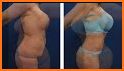 Incredible liposuction related image