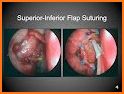 Endoscopic Classifications related image