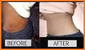 STRETCH MARK REMOVAL related image