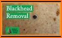 Blackheads Removal Videos related image