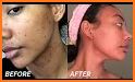 How To Get Rid Of Dark Spots related image