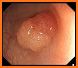 Endoscopic Classifications related image