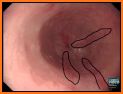 Endoscopic Classifications related image