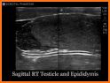 Scrotal Ultrasound related image