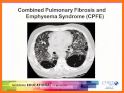 Rad Rounds - UIP to IPF related image