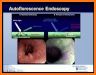 Endoscopic Classifications related image