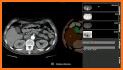 Abdominal CT Sectional Walker related image