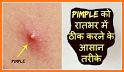 Acne & Pimples (Home Remedies) related image