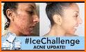 AcneLog: Track your Acne Healing Progress related image