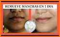 Remedios para las manchas de la cara related image