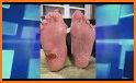 PEDIS Score Diabetes App - Diabetic Foot Ulcer related image