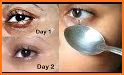 Get Rid of Bags Under Eyes related image