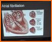 ECG Rhythm and Pulse related image