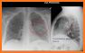 Chest X-Ray Interpretation related image