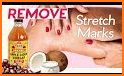 Get Rid Of Stretch Marks Naturally related image