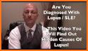 Lupus: Causes, Diagnosis, and Treatment related image